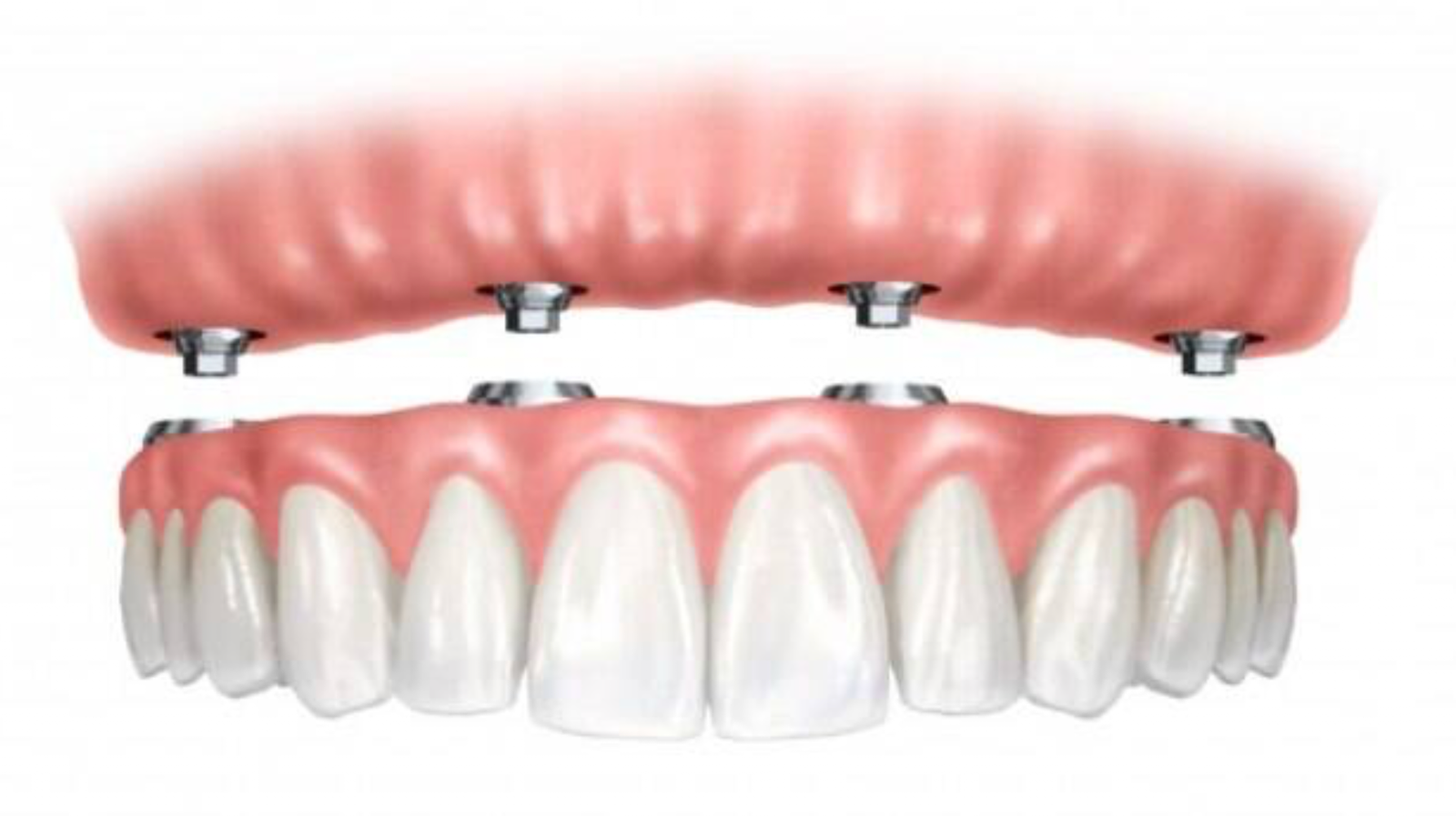 Reabilitação com implantes pela técnica "All on Four"